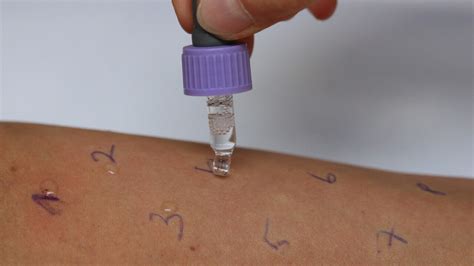 false negative allergy skin test